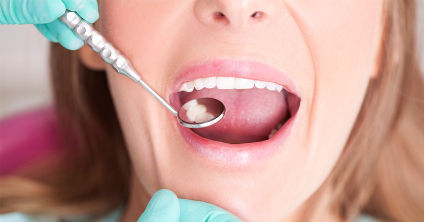 Tooth Colored Fillings in San Antonio TX