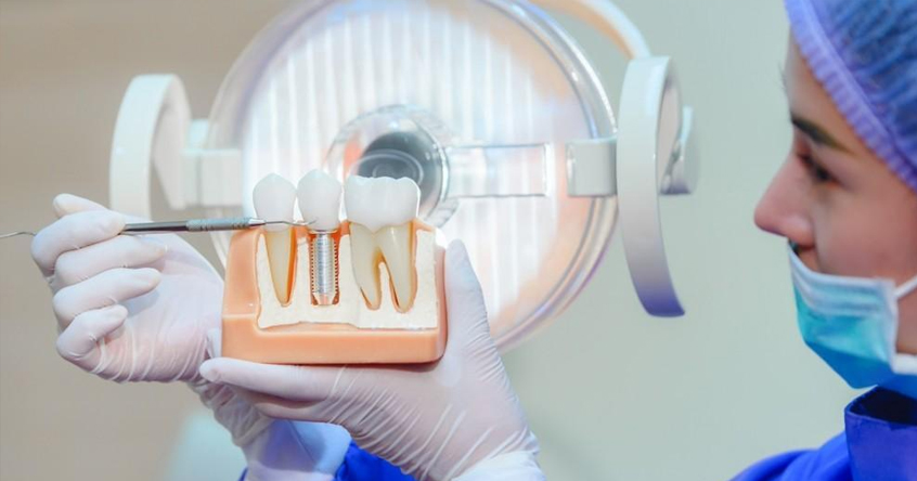 Dental Implants in San Antonio TX