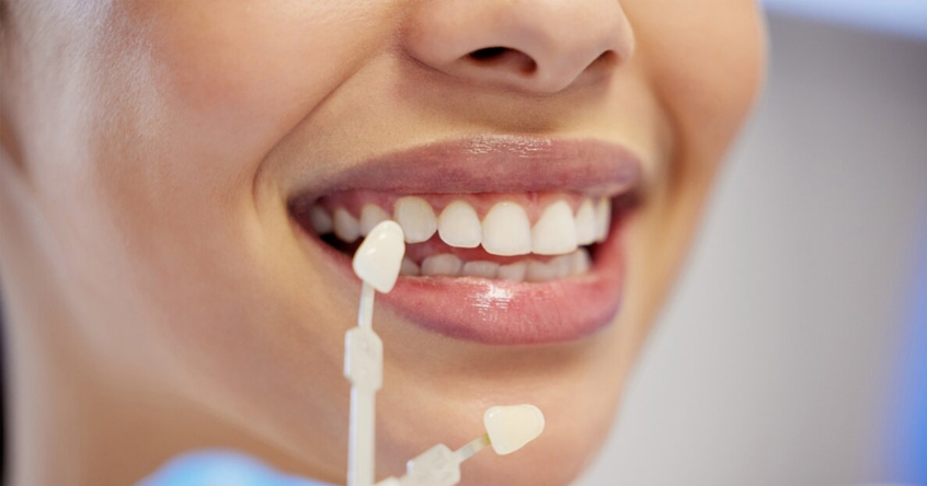 Dental Veneers in San Antonio TX
